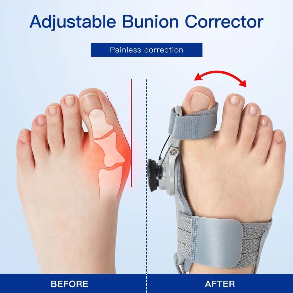 Correggi i tuoi bunions senza dolore né intervento 